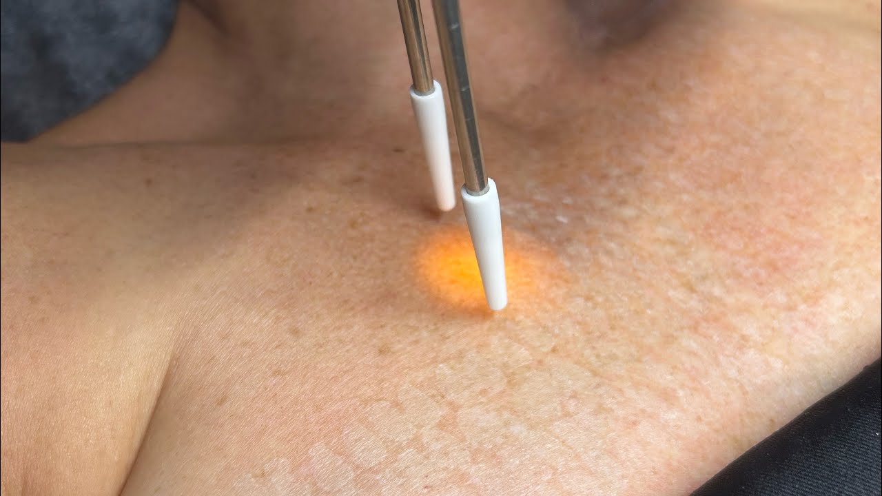 Experienced Skin Tag Removal Experts in Bradford